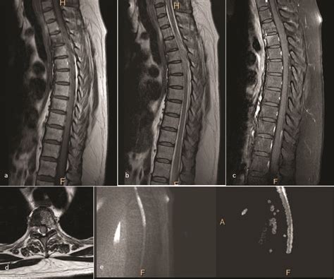 Spinal Cord Haemorrhage