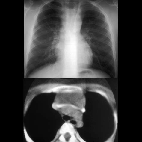 Thymic Cyst Pediatric Radiology Reference Article Pediatric Imaging Pedsimaging