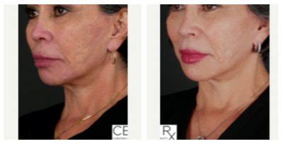 Opus Plasma Skin Resurfacing Buckhead Plastic Surgery In Atlanta Ga