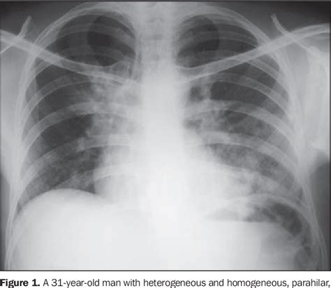 Figure From Radiological Findings Of Pulmonary Tuberculosis In