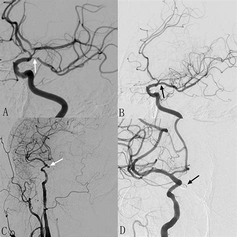 Frontiers Intervals Of Endovascular Treatment For Coincidental Non