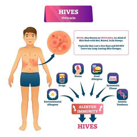 Urticaria Rash Causes