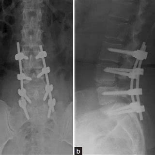 Preoperative Radiographic And MRI Images A Anteroposterior