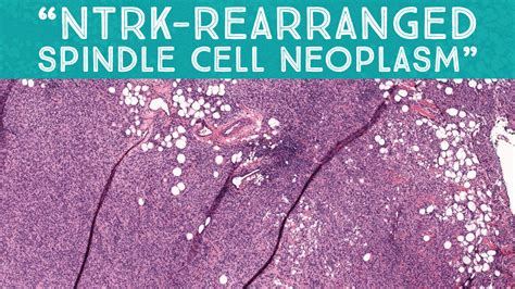 “ntrk Rearranged Spindle Cell Neoplasm” Aip France 2021 Case 16