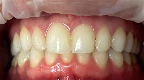 Porcelain Veneers San Diego Ca Dental Veneers