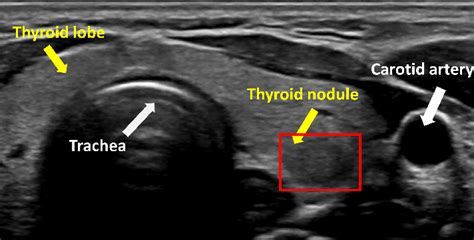 Thyroid Cancer Nodules Ultrasound