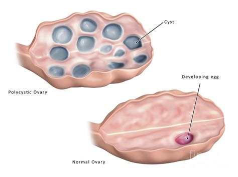 Polycystic Ovary By Science Photo Library