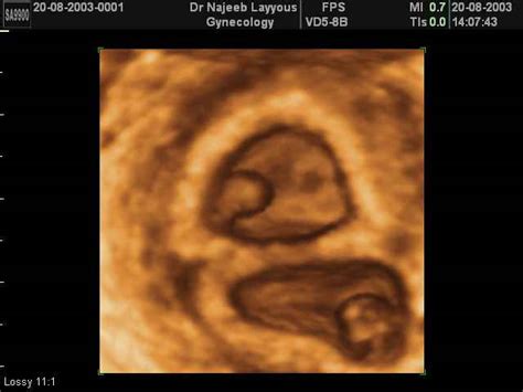 Pregnant With Quintuplets Ultrasound