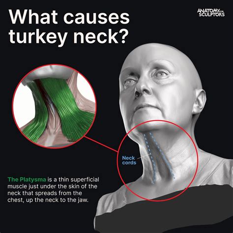 Fat Doesnt Cause Turkey Neck With Age The Platysma Muscle Weakens