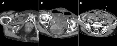 An 86 Year Old Female Patient With An Obturator Hernia Causing Small