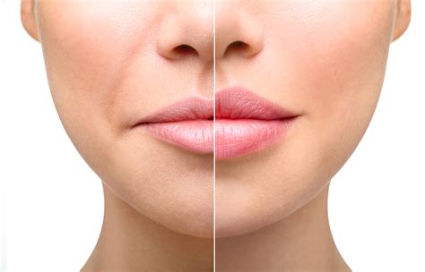 Preenchimento Labial Mega Clinic Esthetic