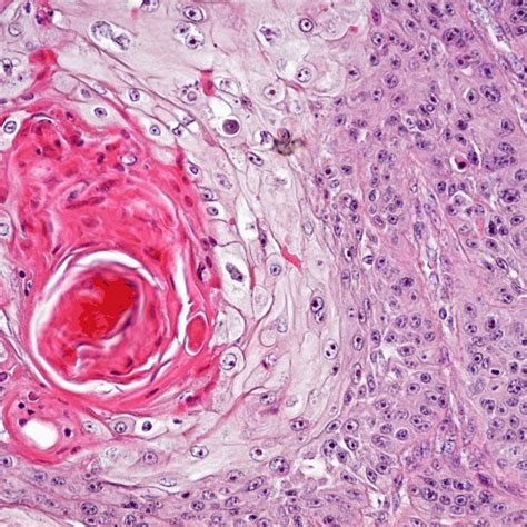 Sland Of Moderately Differentiated Squamous Cell Carcinoma With