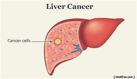 Liver Cancer Treatment Surgery Procedures Risks Complications And Faqs