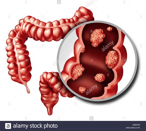 Colorectal Cancer High Resolution Stock Photography And Images Alamy