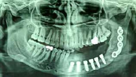 Reconstruction Of Segmental Mandibular Defect With Free Iliac Graft Download Scientific Diagram