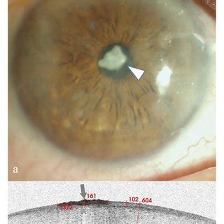 Anterior Segment And As Oct Image For Case A Anterior Segment