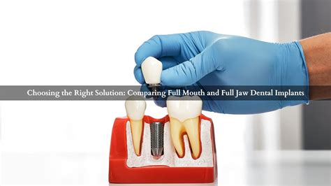 The Comprehensive Guide To Full Mouth Dental Implants Everything You Need To Know By 21d