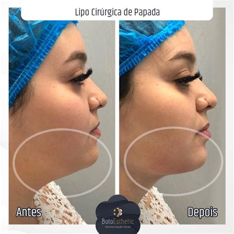 Lipo De Papada Cl Nica Botoesthetic