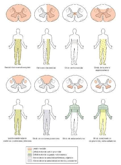 Lesión medular introducción y papel de la rehabilitación