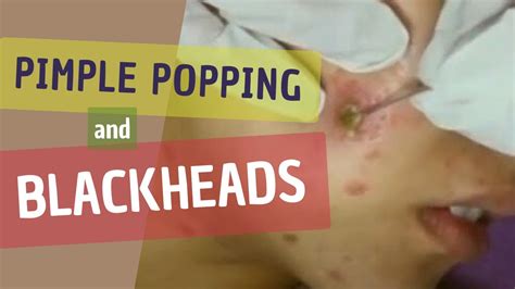 Blackheads & Big Cystic Acne Extraction - YouTube