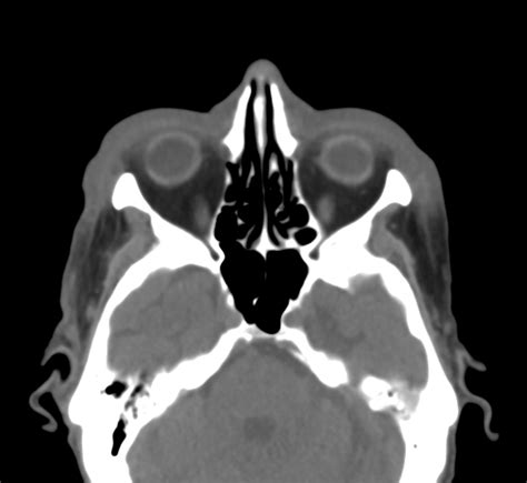 Bilateral Preseptal Periorbital Cellulitis Image