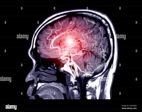 Mra Brain Or Magnetic Resonance Angiography Mra Of Cerebral Artery