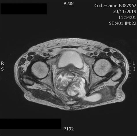 Axial T2 Weighted Tse Image Shows A Mid Rectal Tumor Infiltrating The