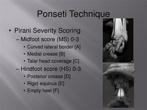 Ppt Ponseti Casting And Technique For Pediatric Clubfoot Management Powerpoint Presentation