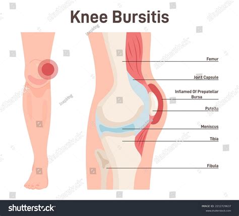 Bursitis Knee Joint Inflammation Inflamed Irritated: เวกเตอร์สต็อก (ปลอดค่าลิขสิทธิ์) 2212729637 ...