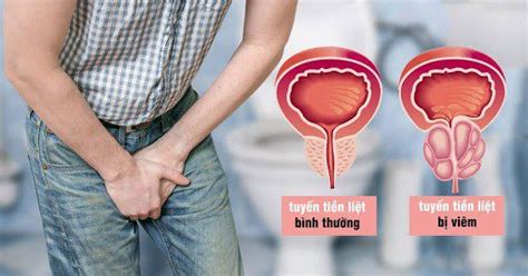 Xuất tinh bị đau là bệnh gì Vinmec