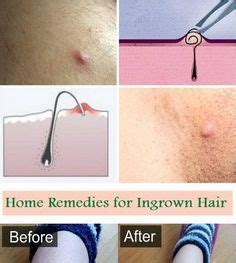 9 Best Ingrown Hair ideas | ingrown hair, ingrown hair removal, simple ...