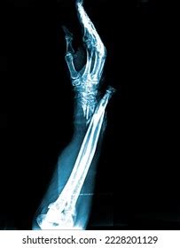 Film Xray Complete Fracture Forearm Stock Photo 2228201129 | Shutterstock