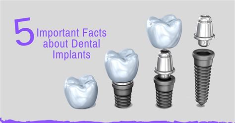 5 Important Facts About Dental Implants Denta Kings