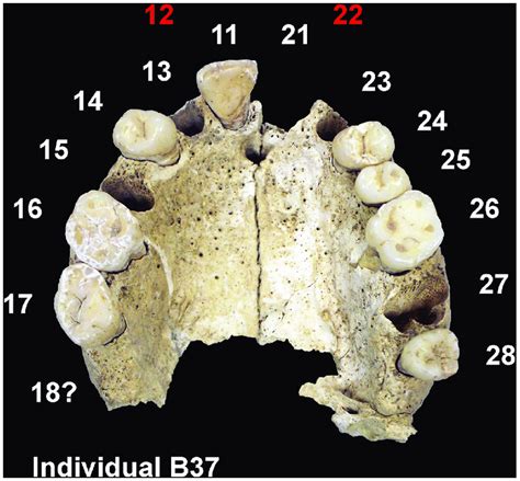 Bilateral Maxillary Lateral Incisor Agenesis MLIA From The