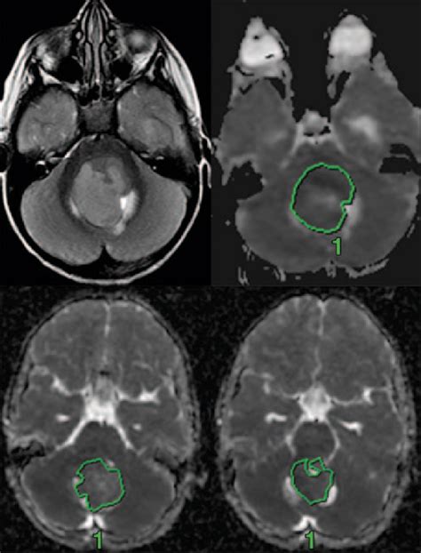 Apparent Diffusion Coefficient Of Human Brain Tumors At Mr Imaging