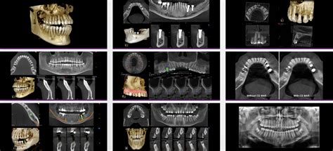 A New Method Assessing Predicted And Achieved Mandibular Off