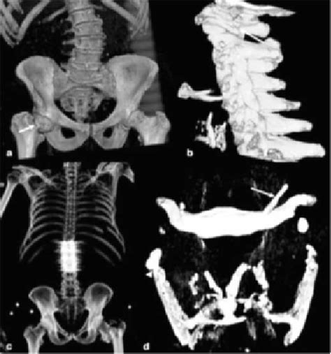 Multislice Computed Tomography Of The Abdomen Intrahepatic Gas In The