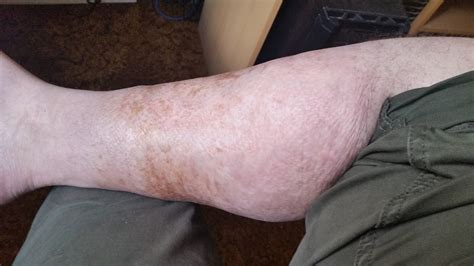 Leg Scar From 3rd Degree Burn In 2008 Imgur