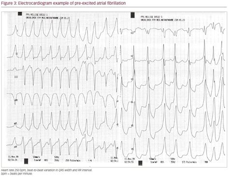 Supraventricular Tachycardia Electrocardiogram Diagnosis And Clinical