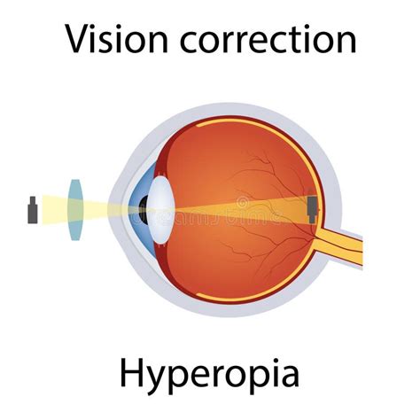 Vision Correction Of Hyperopia Illustration Eyesight Disorders Eyes Defect Corrected By Convex