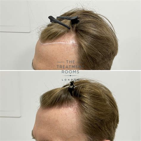 Hair Transplant Before And After 1700 Grafts Treatment Rooms London