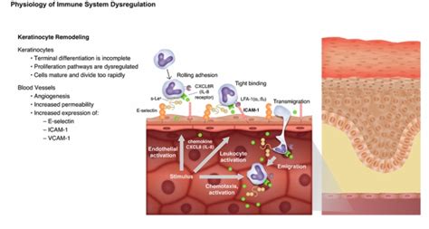 Psoriasis_Pathophysiology