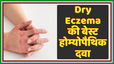 Best Homeopathic Medicine For Dry Eczema