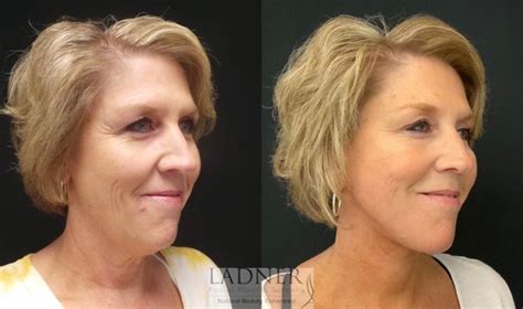 Lower Face Lift Submental Liposuction Platysmaplasty