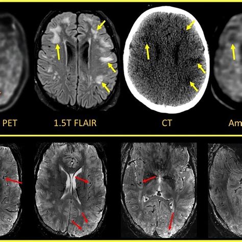 Amyloid PET ¹⁸F florbetapir imaging demonstrates amyloid deposition