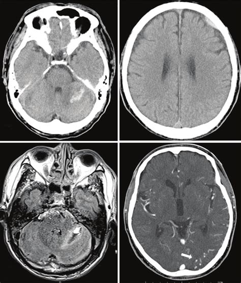 Ct Scanning Reveals An Intracranial Hemorrhage In The Left Cerebellar