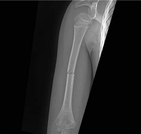 Humeral Shaft Fracture Pediatric Pediatrics Orthobullets