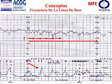 Monitoreo Fetal Electronico Ppt