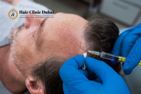 The Role Of Platelet Rich Plasma Prp In Hair Restoration