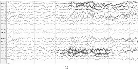 Eeg In Focal And Generalized Epilepsies Pearls And Perils Epilepsy And Behavior